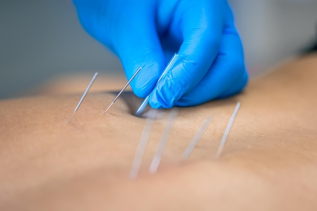 columbus ohio dry needling services