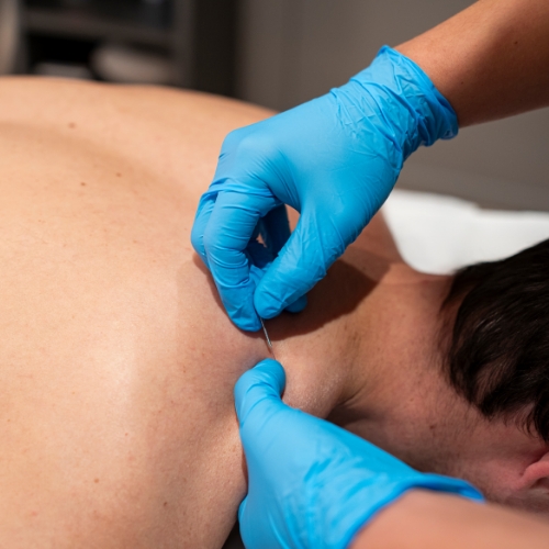 dry-needling-FYZICAL-Therapy-and-Balance-Centers-Upper-Arlington-Columbus-OH
